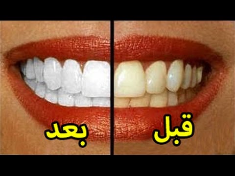 طريقة تبييض الاسنان