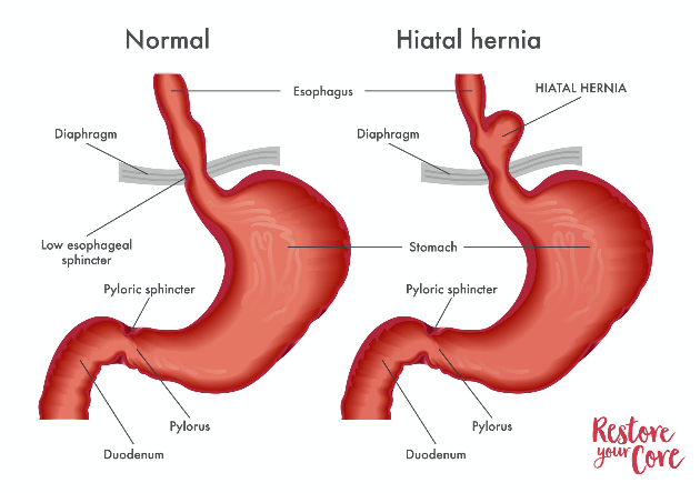 types of hernia