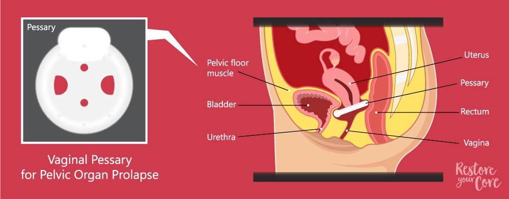 pessary for pelvic organ prolapse