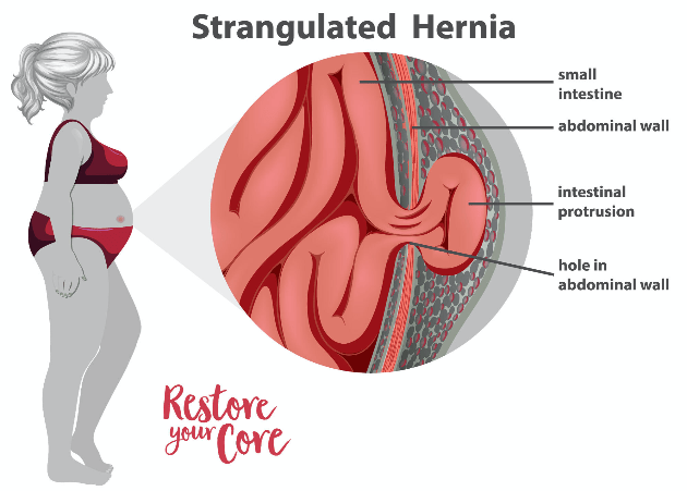 strangulated hernia