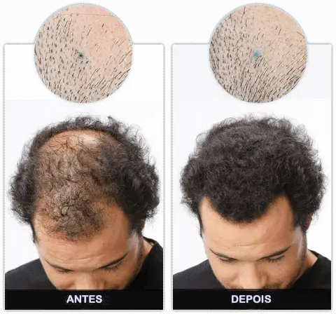 Folixil Antes e Depois