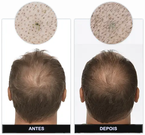 Folixil Antes e Depois