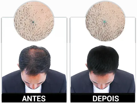 Folixil Antes e Depois