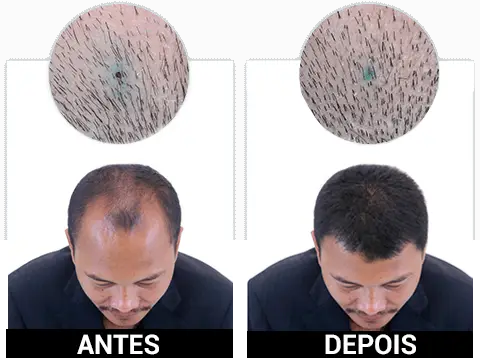 Folixil Antes e Depois