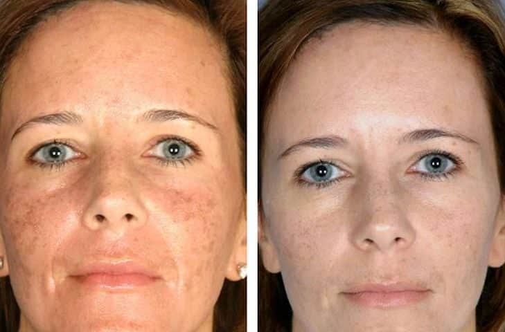 melasma tratamento