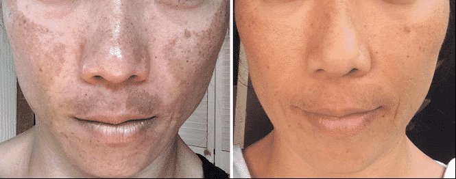 tratamento para melasma peeling