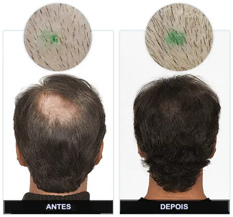 KoruVital Antes e Depois