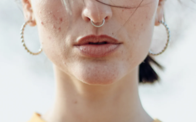 How to Treat a Skin Boil: Identification, Prevention & When You Should See a Dermatologist