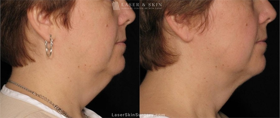 before and after image of laser assisted lipolysis to remove stubborn fat in a woman's chin and neck
