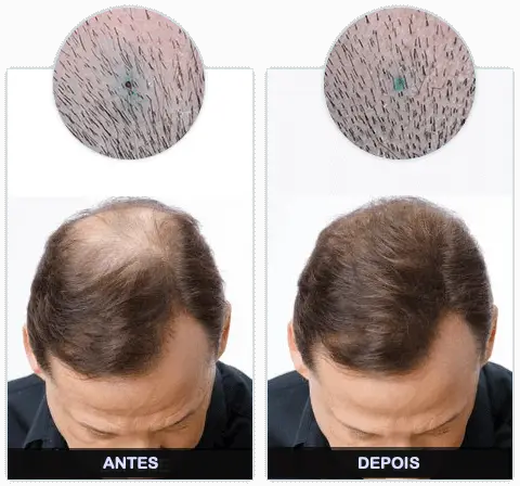 Folixil Antes e Depois