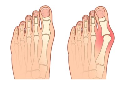 Hallux Valgus