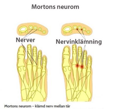 mortons_neurom