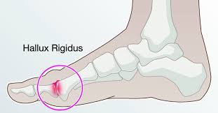 hallux rigidus 