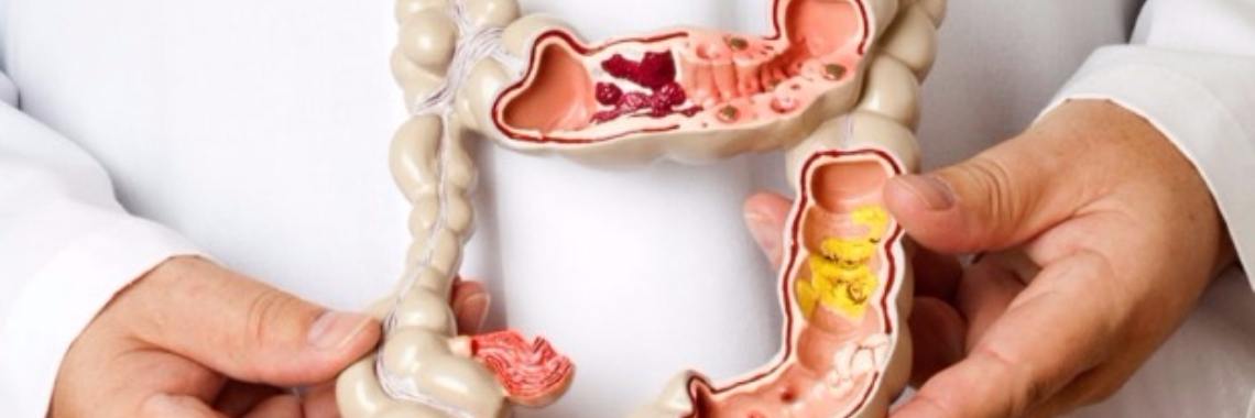 Spastic colon or irratable bowel syndrome.