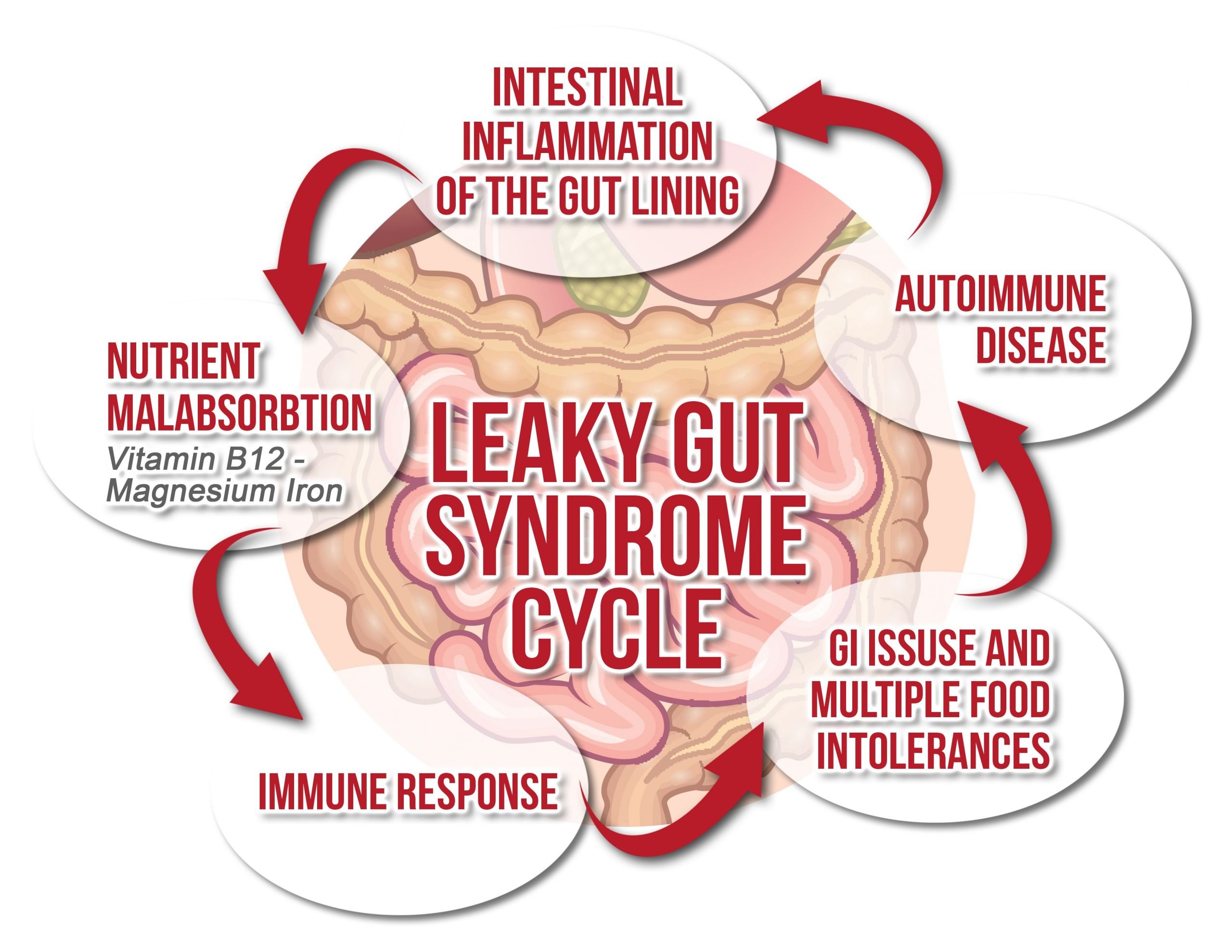 Simple Tips For Treating Leaky Gut Syndrome Efficiently